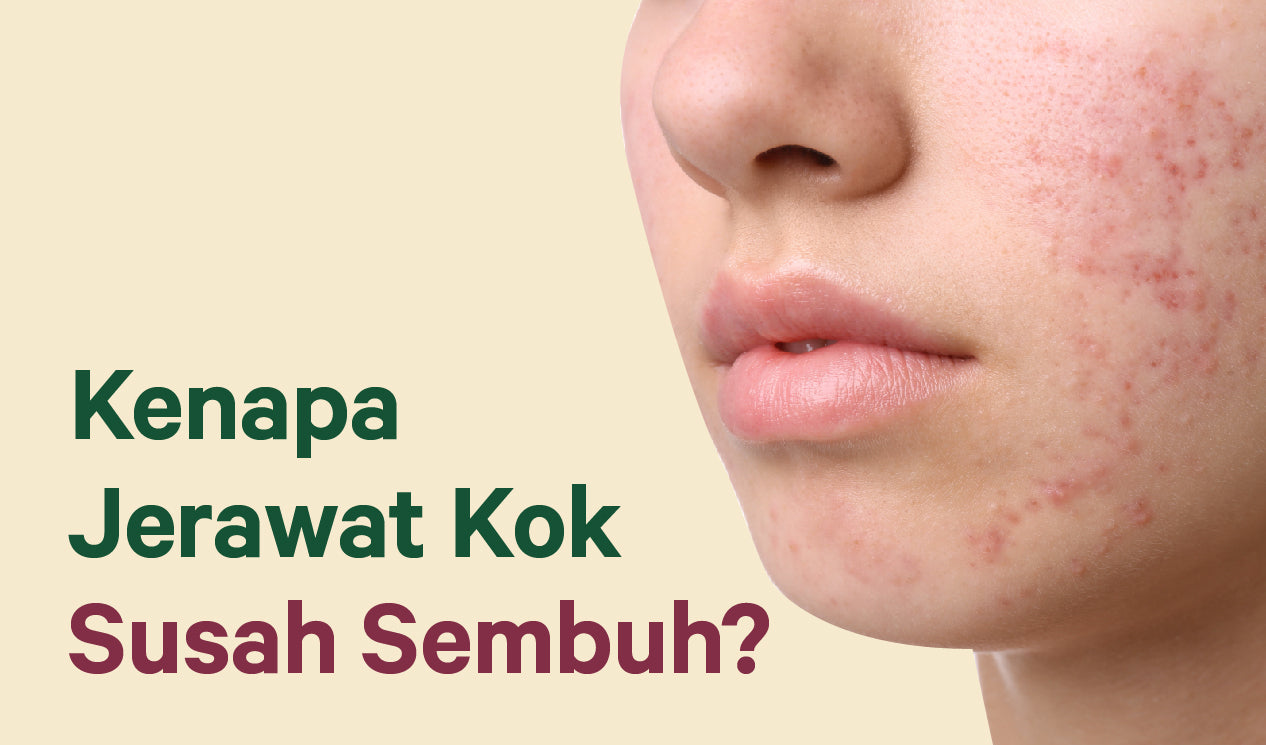Kenapa Jerawat Kok Susah Sembuh?