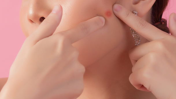 Apa yang Perlu Kamu Ketahui Tentang Jerawat Saat ke Dokter?